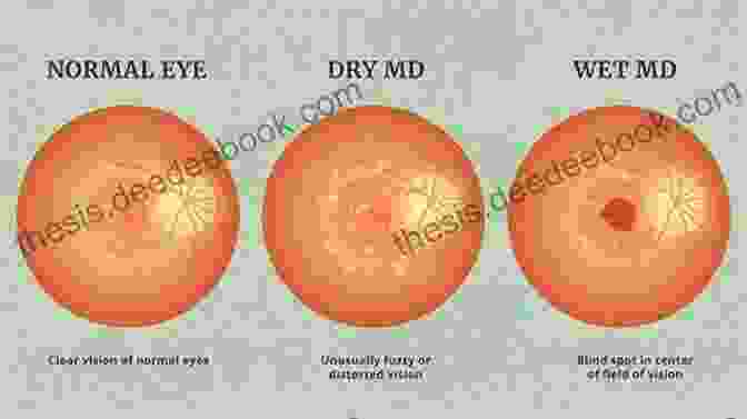 Age Related Macular Degeneration (AMD) Recent Advances In Ophthalmology: Volume 14