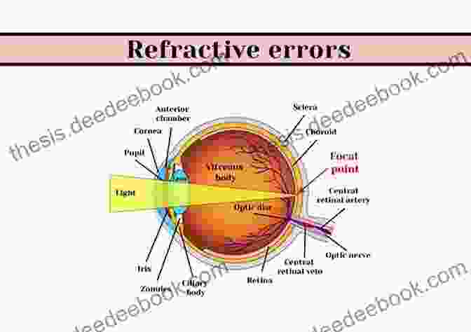 Refractive Errors Recent Advances In Ophthalmology: Volume 14