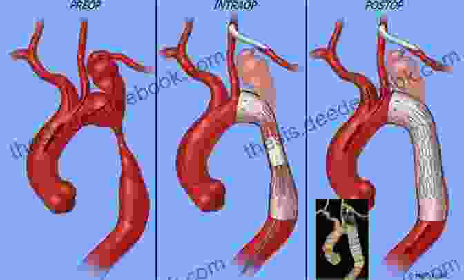 Web Accessibility Example Endovascular Treatment Of Aortic Aneurysms: Standard And Advanced Techniques