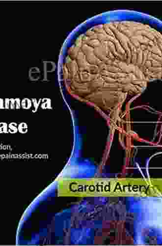 Moyamoya Disease: Diagnosis And Treatment
