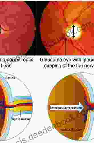 The Optic Nerve Evaluation In Glaucoma: An Interactive Workbook